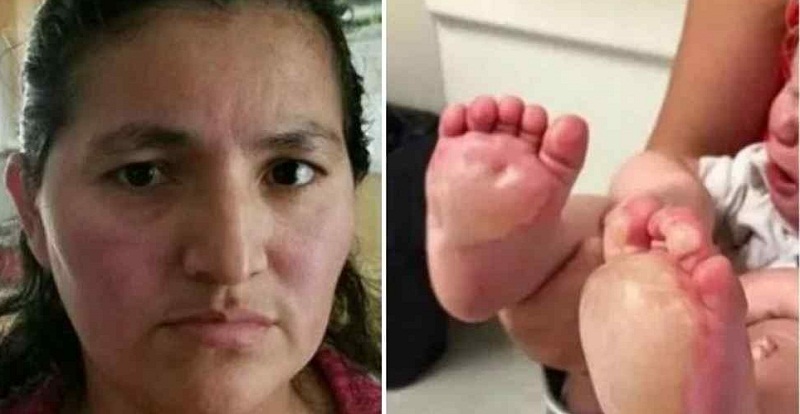 Babá fica irritada com bebê de 6 meses e queima seus pés em uma frigideira quente - Agora RN