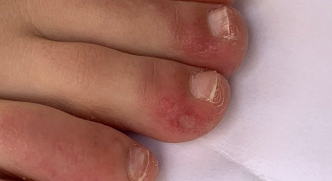 Coronavírus: o que são os 'dedos de Covid', um dos mais novos possíveis sintomas identificados da doença? - Agora RN