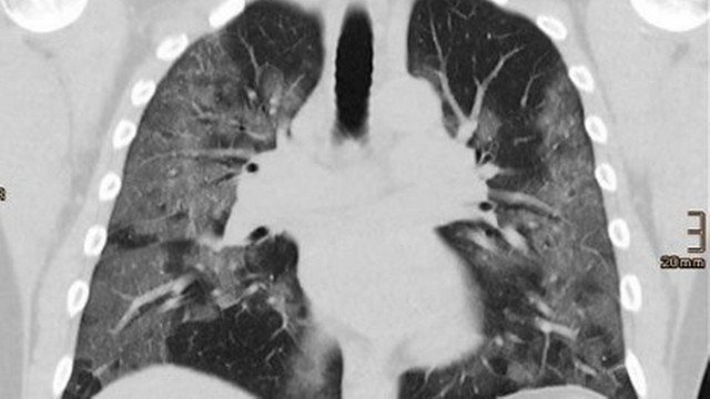 Paciente transplantada morre de covid-19 após receber pulmões infectados