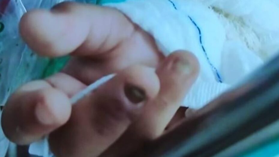Polícia investiga maus-tratos a menina de 2 anos que foi levada a hospital sem duas unhas e com lesões no intestino
