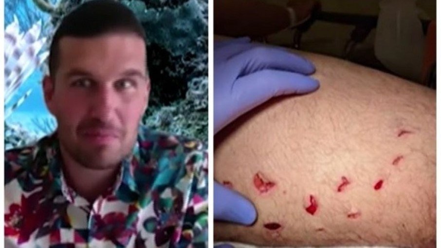 Homem sobrevive a ataque de tubarão-branco e compara: "como uma mordida de mosquito" | notícias do rio grande do norte Homem sobrevive a ataque de tubarão-branco e compara: “como uma mordida de mosquito”