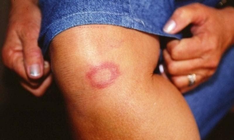 Mais de 2 mil novos casos de hanseníase são registrados no RN em uma década - Agora RN