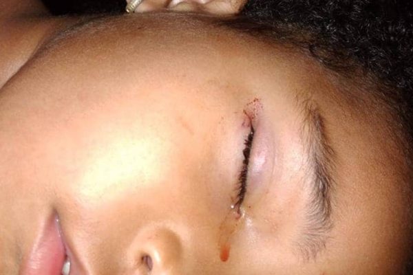 Menina tem olho mordido por rato enquanto dormia: "Quase morri"