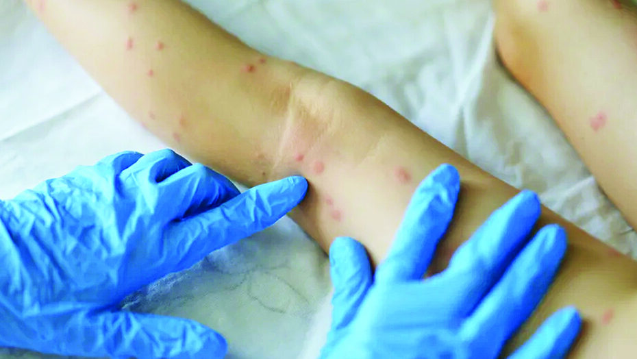 Oms alerta para variante mais perigosa de mpox | notícias do rio grande do norte varioladosmacacos