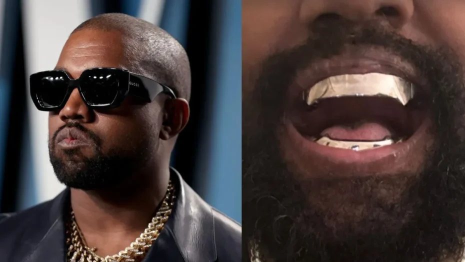 Kanye West coloca prótese de titânio nos dentes avaliada em R$ 4 milhões / Foto: Getty Images e Reprodução/Instagram