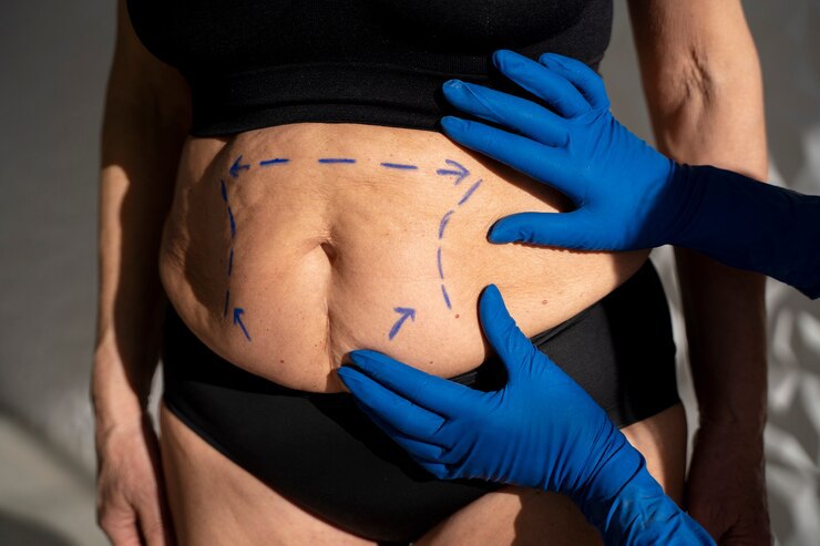 RN tem alto número de obesidade. Foto: Divulgação