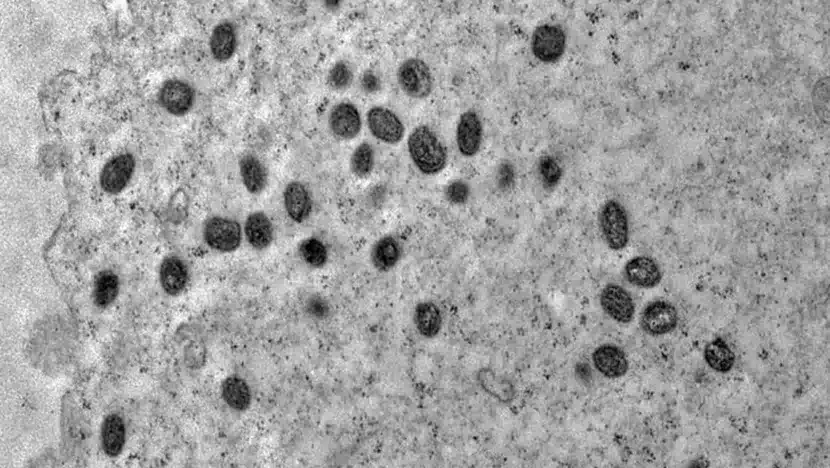 Oms reconhece nova cepa recombinante de mpox após casos no reino unido e na índia | notícias do rio grande do norte Mpox 1140x760