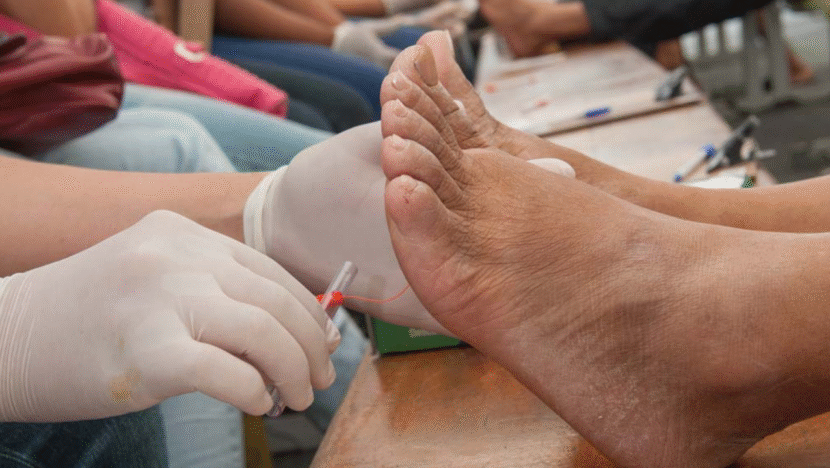 pe diabetico