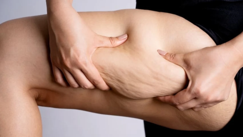 freepik lipedema