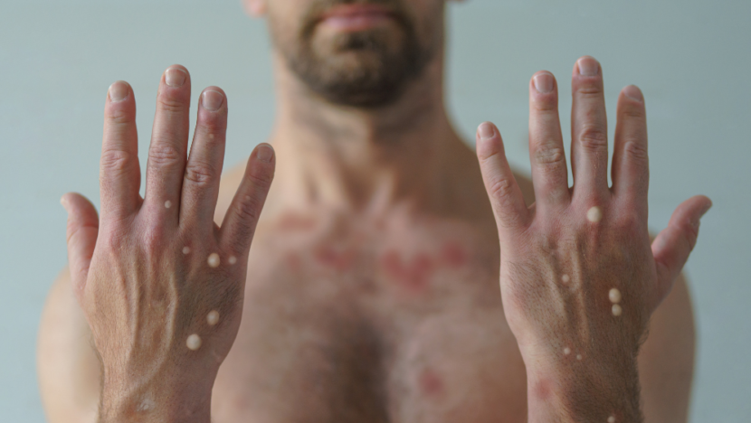 Vírus da mpox pode causar bolhas e erupção na pele. Foto: ITPS/Reprodução