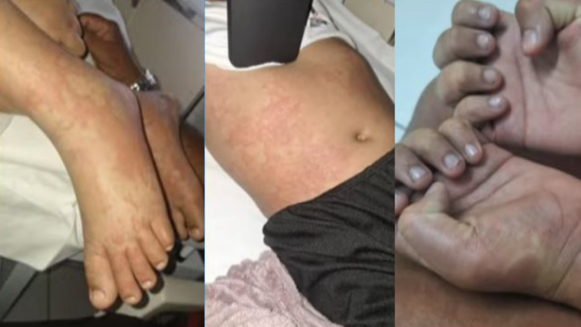 O lote do produto o qual a criança teve acesso é com o final 1, justamente a numeração afetada pela determinação a Agência Nacional de Vigilância Sanitária (Anvisa). Foto: TV Tropical