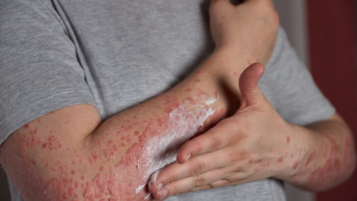 applying moisturizer skin with psoriasis