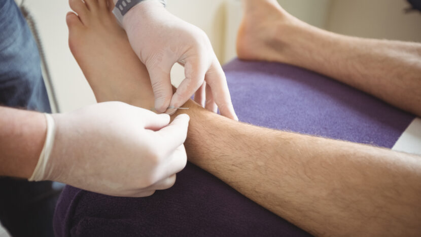 physiotherapist performing dry needling leg patient Copia