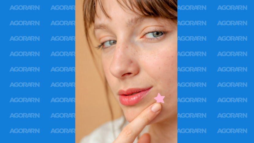Pessoa segura um adesivo rosa em formato de estrela próximo a uma área com pequenas lesões de acne no rosto