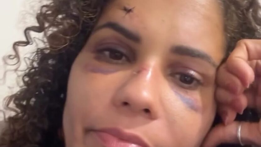Turista que sofreu fratura no maxilar durante tentativa de estupro em Touros