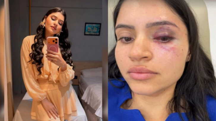 Técnica de enfermagem Ingrid Katerine com marcas de lesões após denunciar agressão em Parnamirim
