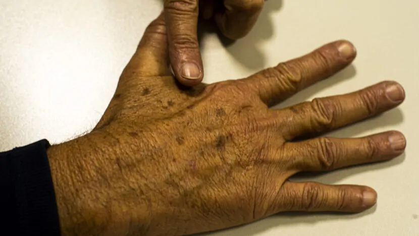 Natal terá mutirão de dermatologistas contra câncer de pele neste sábado 13 | notícias do rio grande do norte Natal terá mutirão de dermatologistas Foto: Marcello Casal Jr.